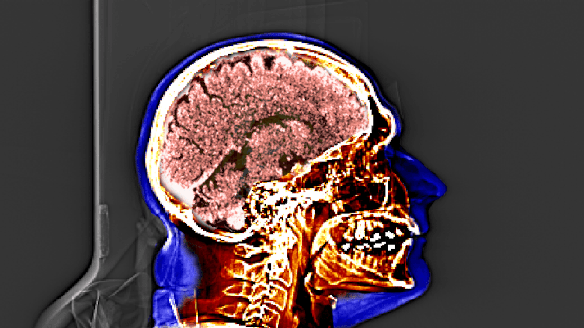Sagittal CT Topogram of head. Exported from Amide.